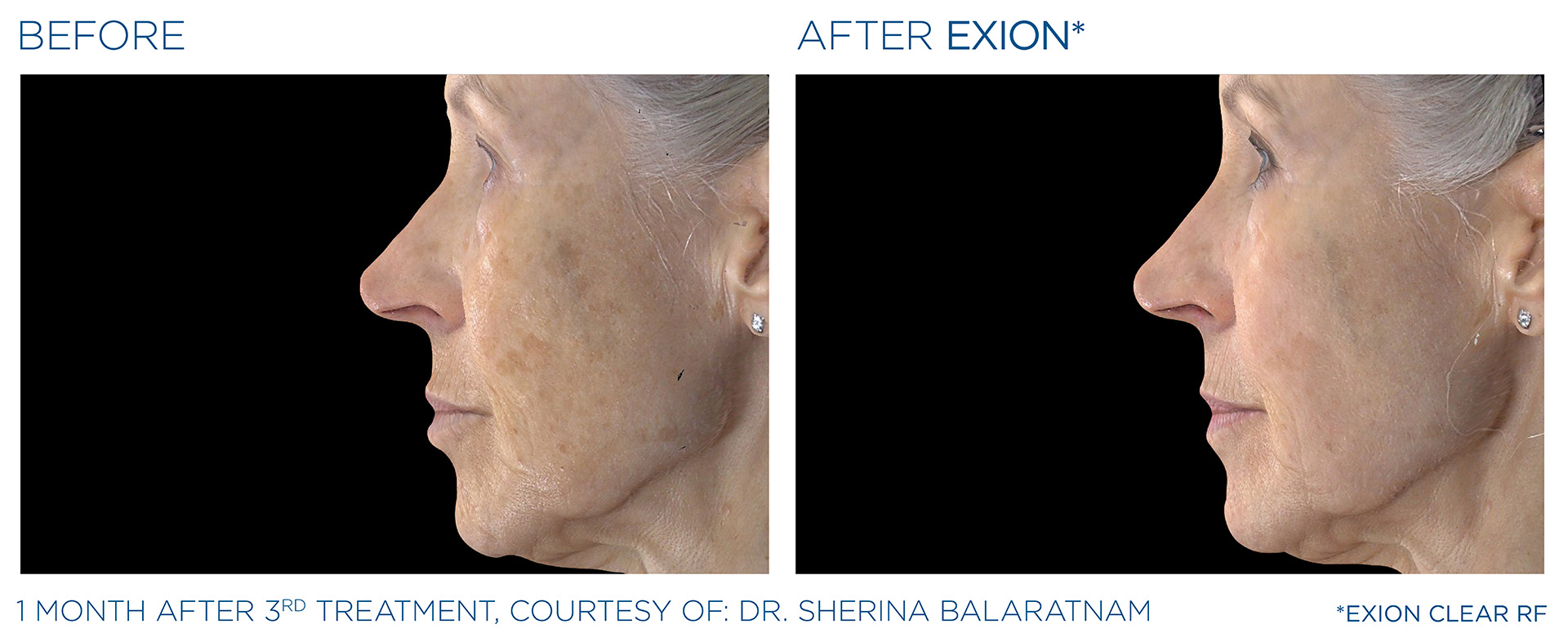 Exion Facial Rejuvenation Mansfield Tx
