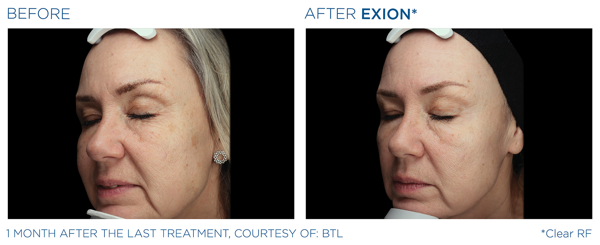 EXION TMJ Relief Mansfield TX
